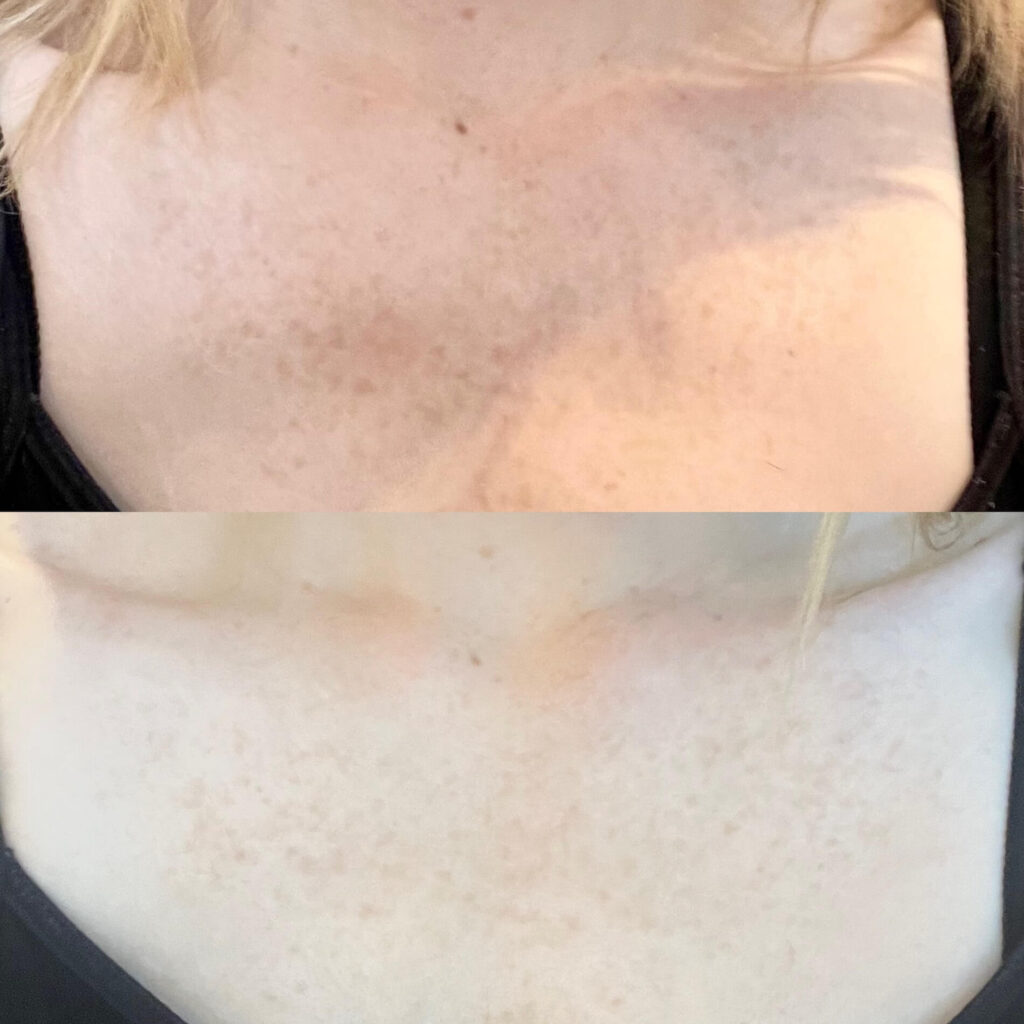 Omnilux Before and After Sun Damage