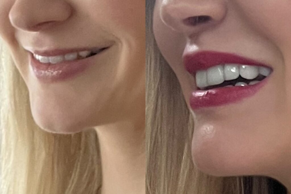 before after lip lift