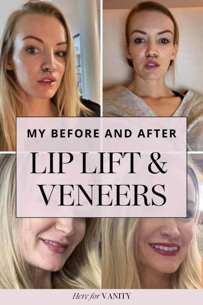 lip lift surgery before after