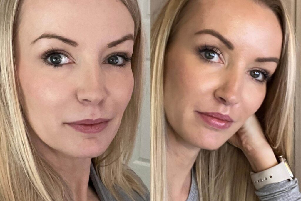 lip lift before and after