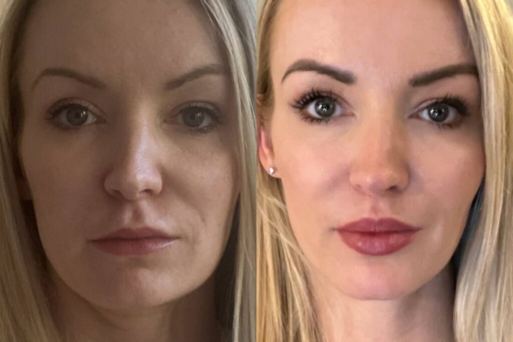 Sculptra Face Before and After