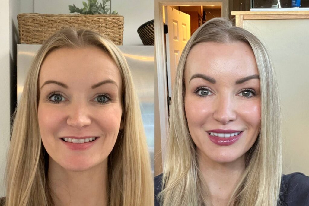 Before and After Sculptra and Veneers