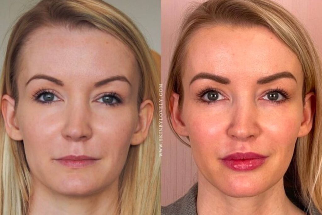 Sculptra photos before and after 