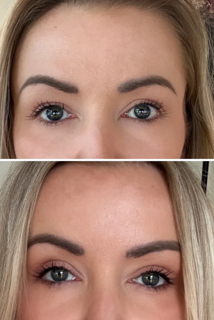blepharoplasty before and after