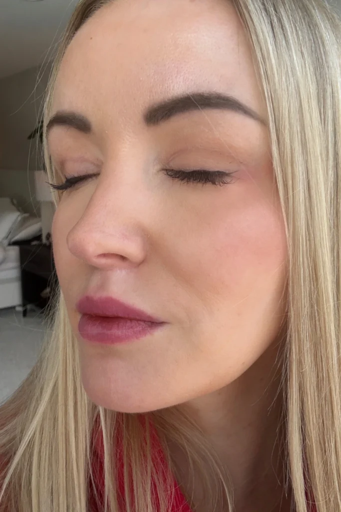 Blepharoplasty recovery timeline