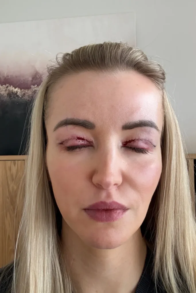 upper blepharoplasty timeline