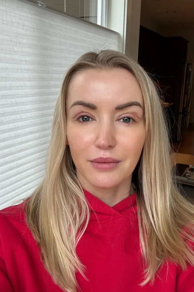 Day 3 Upper Bleph recovery