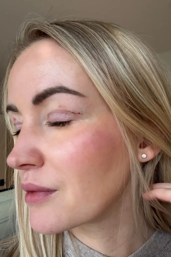  Upper Bleph Before and After