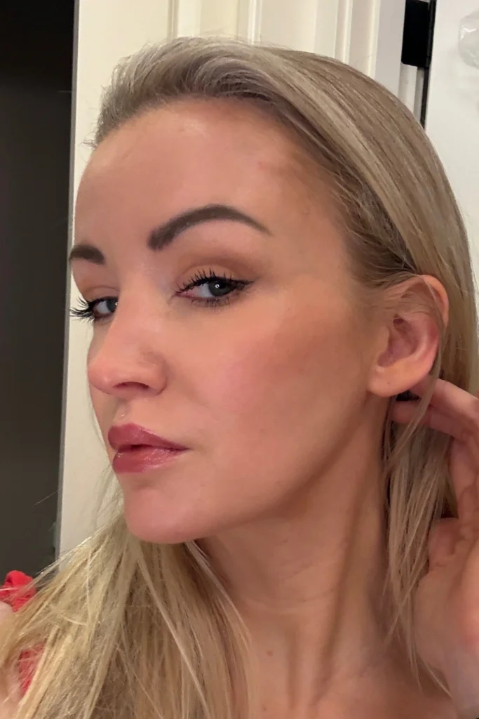 eyelid surgery day by day