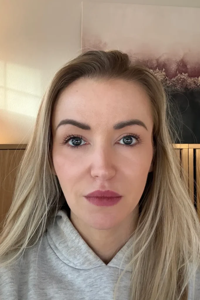 before and after blepharoplasty