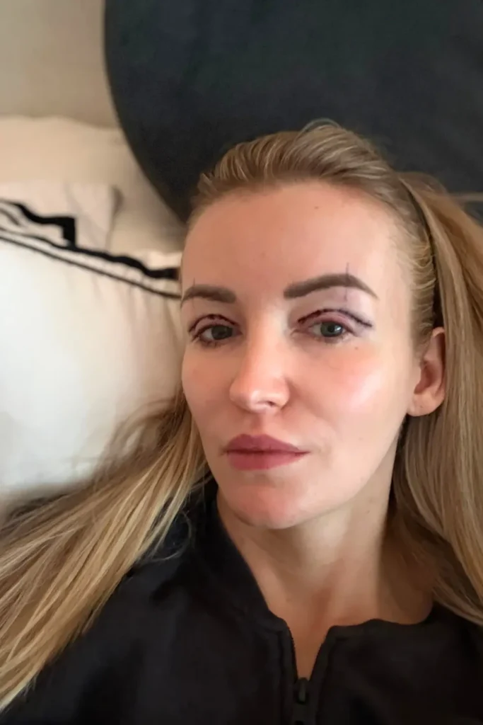 upper blepharoplasty recovery