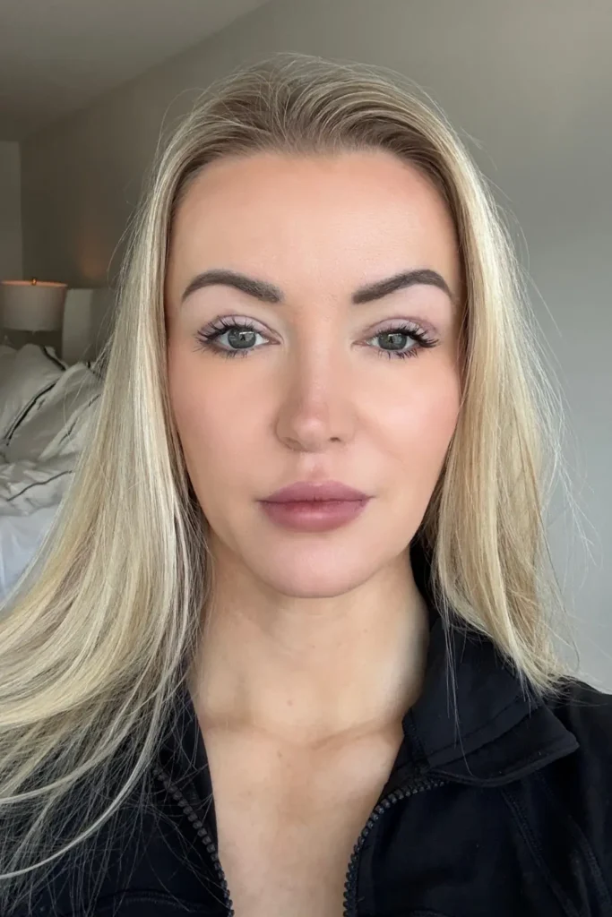 blepharoplasty results