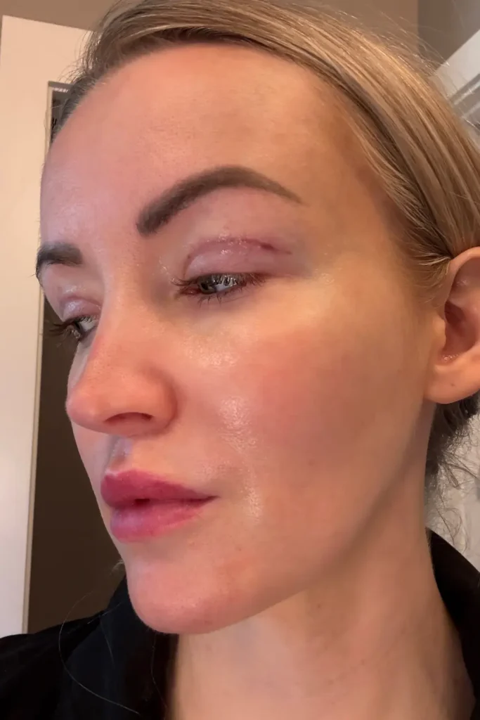 day 14 upper blepharoplasty 