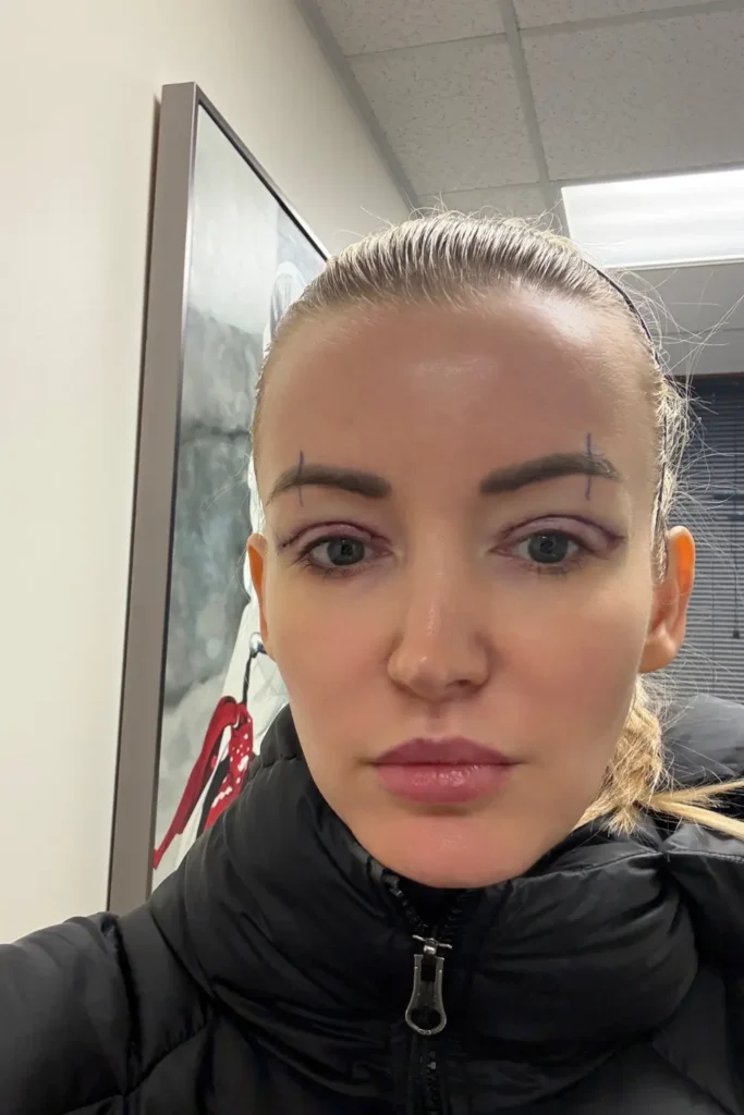 blepharoplasty surgery before after