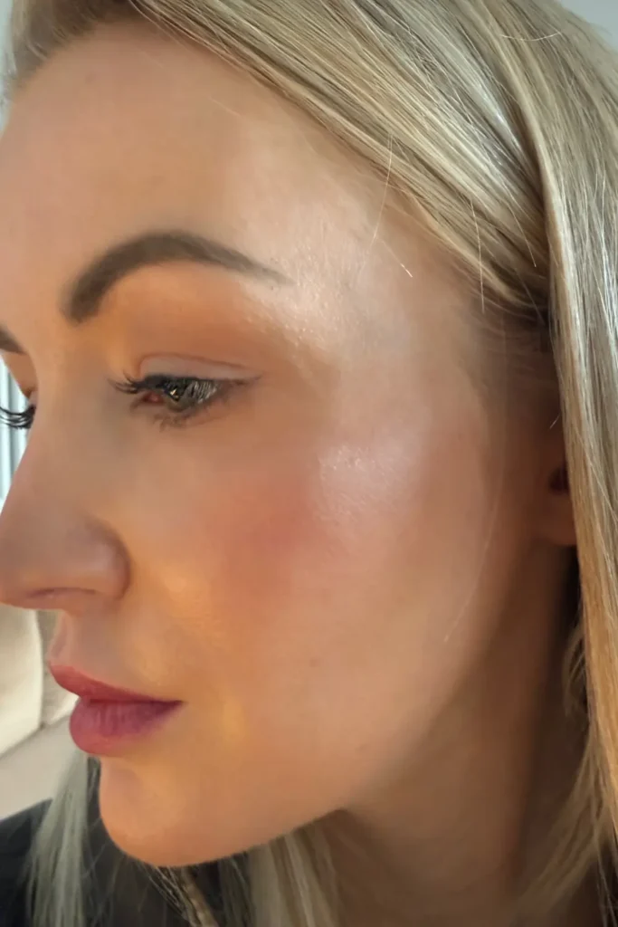 upper blepharoplasty cost