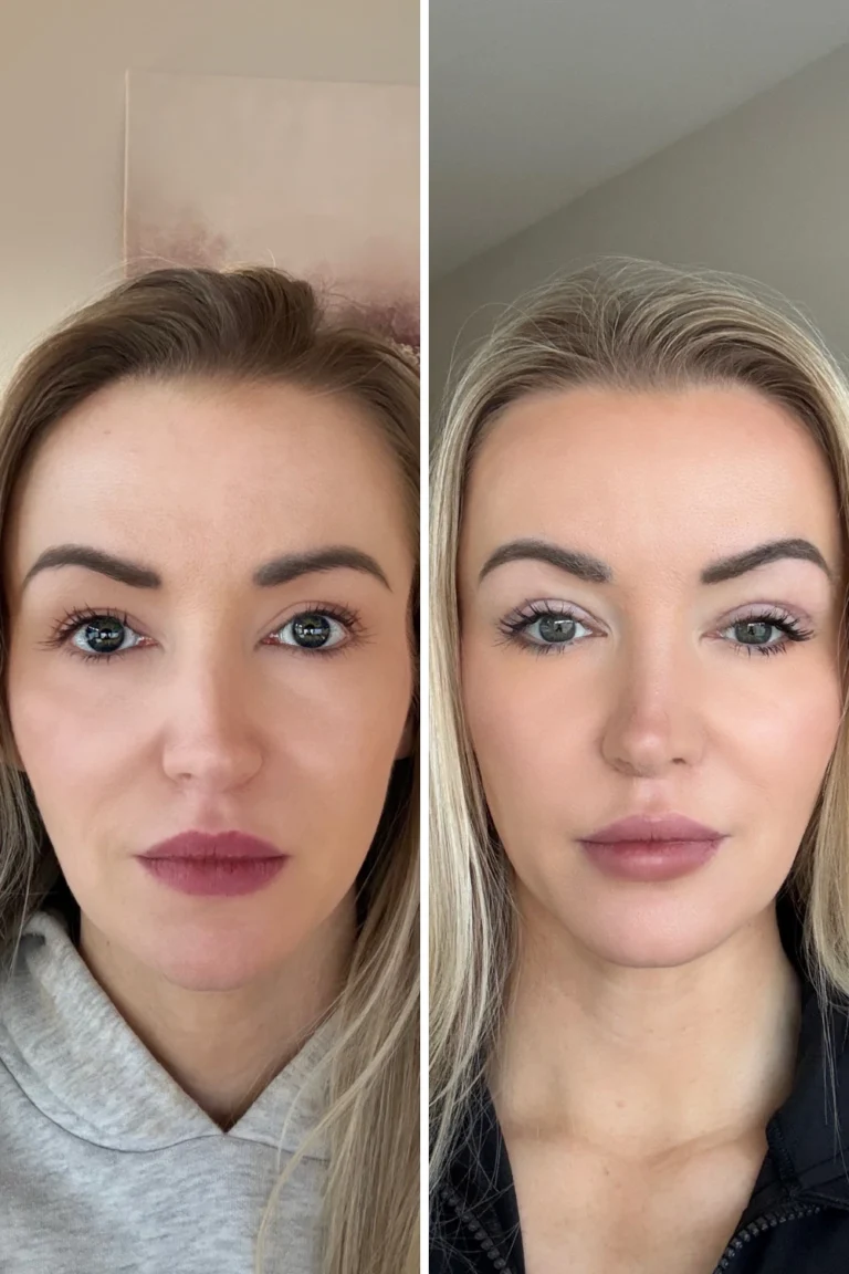 upper blepharoplasty before and after